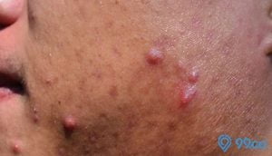 Cara Mengatasi Jerawat Meradang Di Pipi