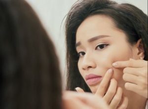 Cara Menghilangkan Bekas Jerawat Akibat Dipencet