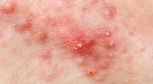 Penyakit Kulit Karena Bakteri