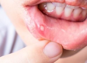 Cara Menghilangkan Sariawan