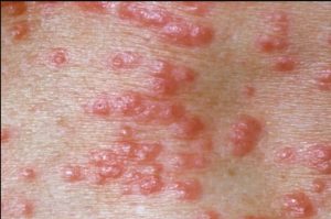 Cara Menghilangkan Kudis