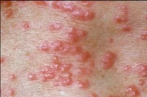 Cara Menghilangkan Kudis